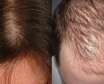 تفاوت ریزش مو در زنان و مردان و روش درمان آن