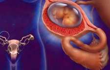 تشخیص حاملگی خارج رحم