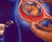 تشخیص حاملگی خارج رحم