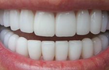 کاربرد روکش دندان و انواع آن