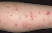 از کجا بدانیم چه نوع حشره ای ما را نیش زده است