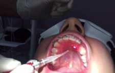 در مورد دندان های نهفته بیشتر بدانیم