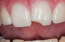 راهکاری برای دندان هایی که می شکنند