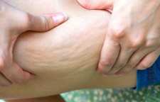 رژیم غذایی و عادات غذایی مفید برای درمان و از بین بردن سلولیت