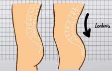 آموزش درمان گودی کمر با ورزش