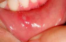 آشنایی با بیماری آفت دهان و دلیل ایجاد آن