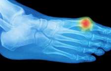 انحراف شست پا و درمان آن