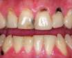 علت و درمان لکه های قهوه ای روی دندان
