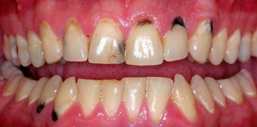 علت و درمان لکه های قهوه ای روی دندان