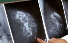 هوش مصنوعی موفق به تشخیص زود هنگام سرطان سینه شد