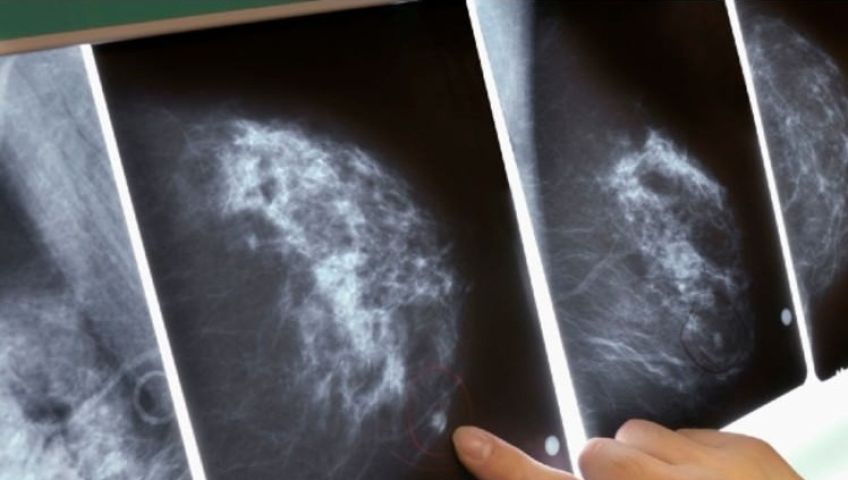 هوش مصنوعی موفق به تشخیص زود هنگام سرطان سینه شد
