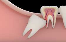 آیا دندان عقل را باید بکشیم و علت جراحی دندان عقل چیست