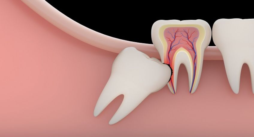 آیا دندان عقل را باید بکشیم و علت جراحی دندان عقل چیست