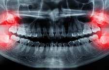 کاربرد دندان عقل و دلیل نکشیدن آن