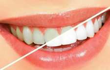 14 راه فوری و طبیعی سفید کردن دندان ها به روش خانگی