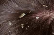 درمان خانگی شوره سر