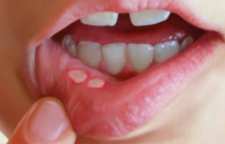 روش خانگی برای درمان زخم های دهانی