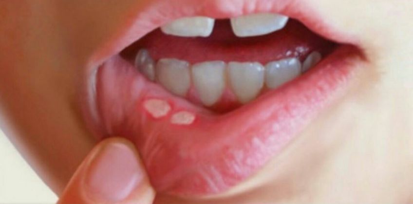 روش خانگی برای درمان زخم های دهانی