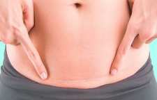 جراحی زیبایی شکم و خطرات ناشی از آن