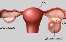 در مورد تنبلی تخمدان بدانیم