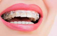 همه ی آنچه باید قبل از ارتودنسی بدانید