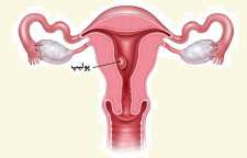 پولیپ رحم و راه های درمان آن