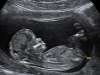 روش های تشخیص جنین دو جنسه در زمان بارداری