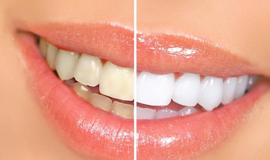 چگونه دندان های خود را زیباتر کنیم؟