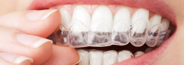 کاور دندان چیست و چه کاربردی دارد